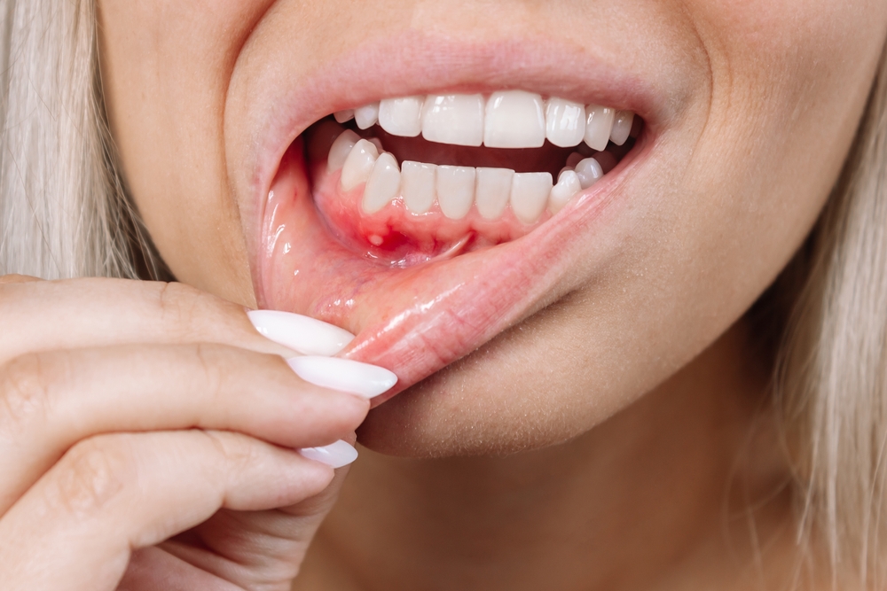 Mouth ulcers treatment near me guntur