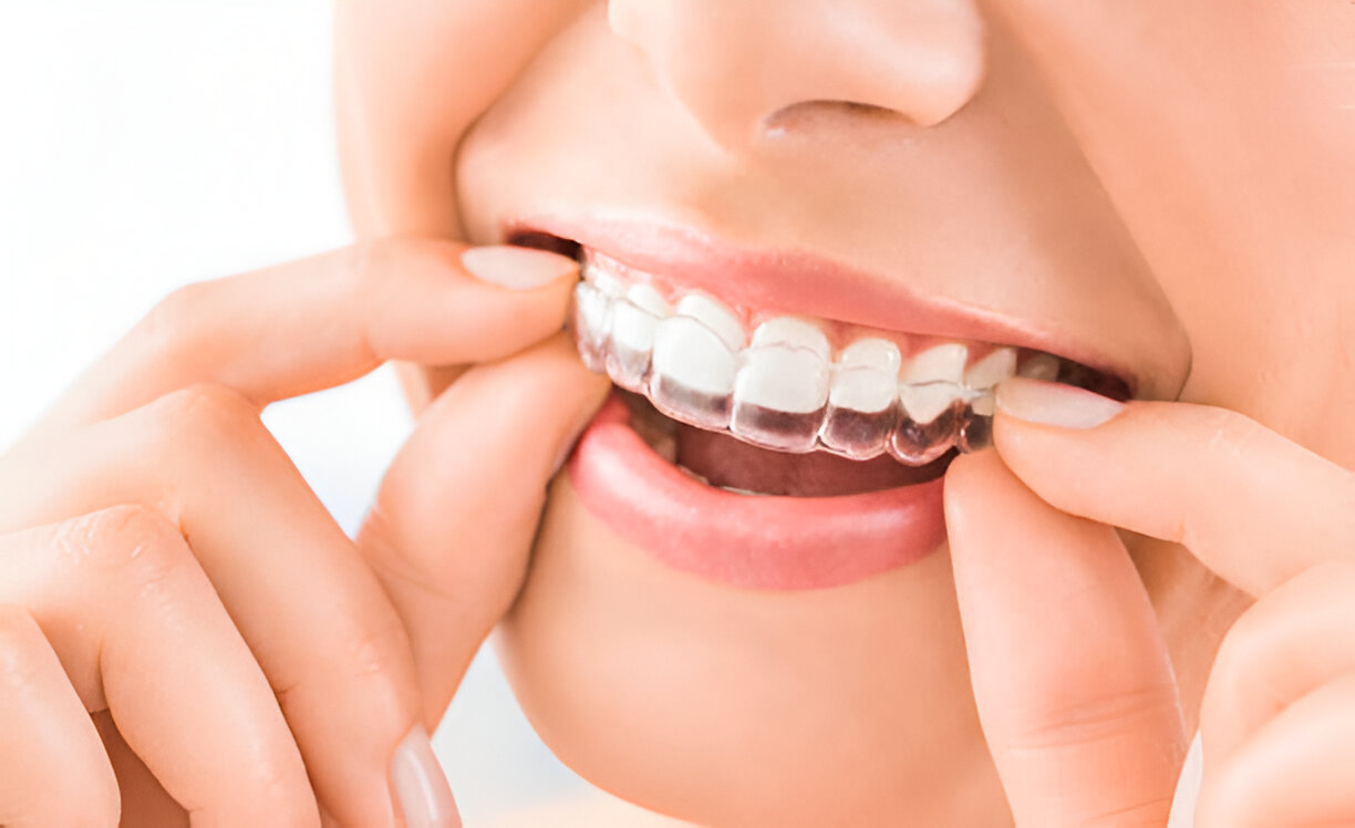 clear aligners