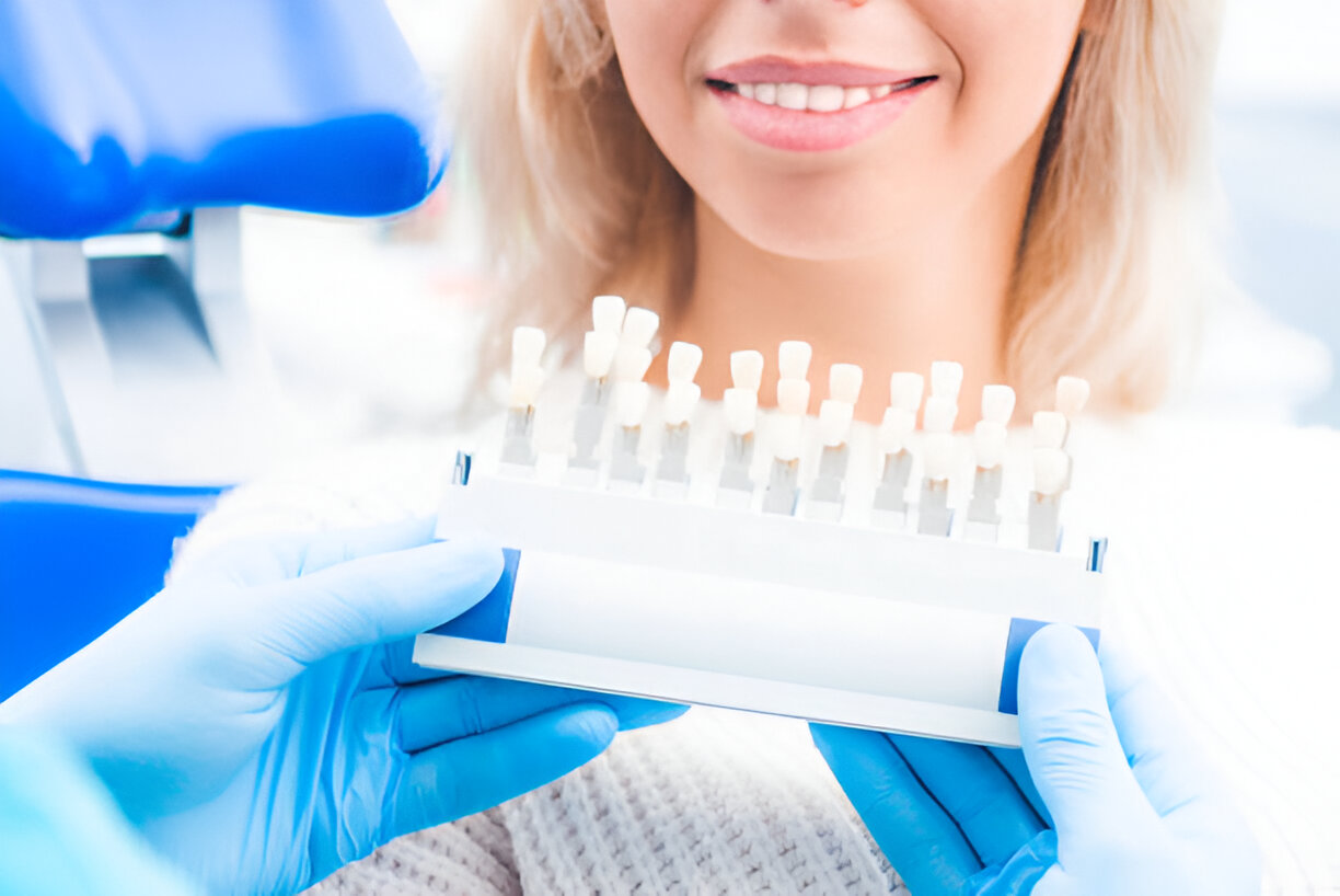 Cosmetic dental Laminates and veneers
