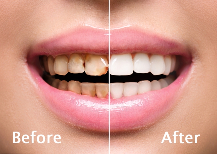 Laser bleaching for Teeth whitening dental clinic near me Guntur