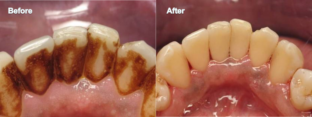 Teeth cleaning guntur near me