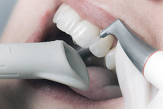 Teeth whitening (scaling) and air polisher near me, guntur