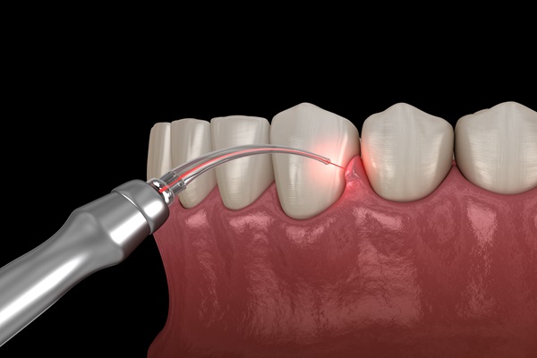 Laser Gum treatment near me Guntur