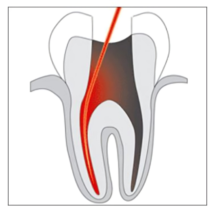 best dental hospital for root canal in Guntur