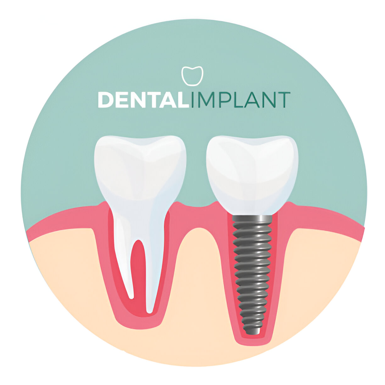 Best dental clinic for Dental Implants