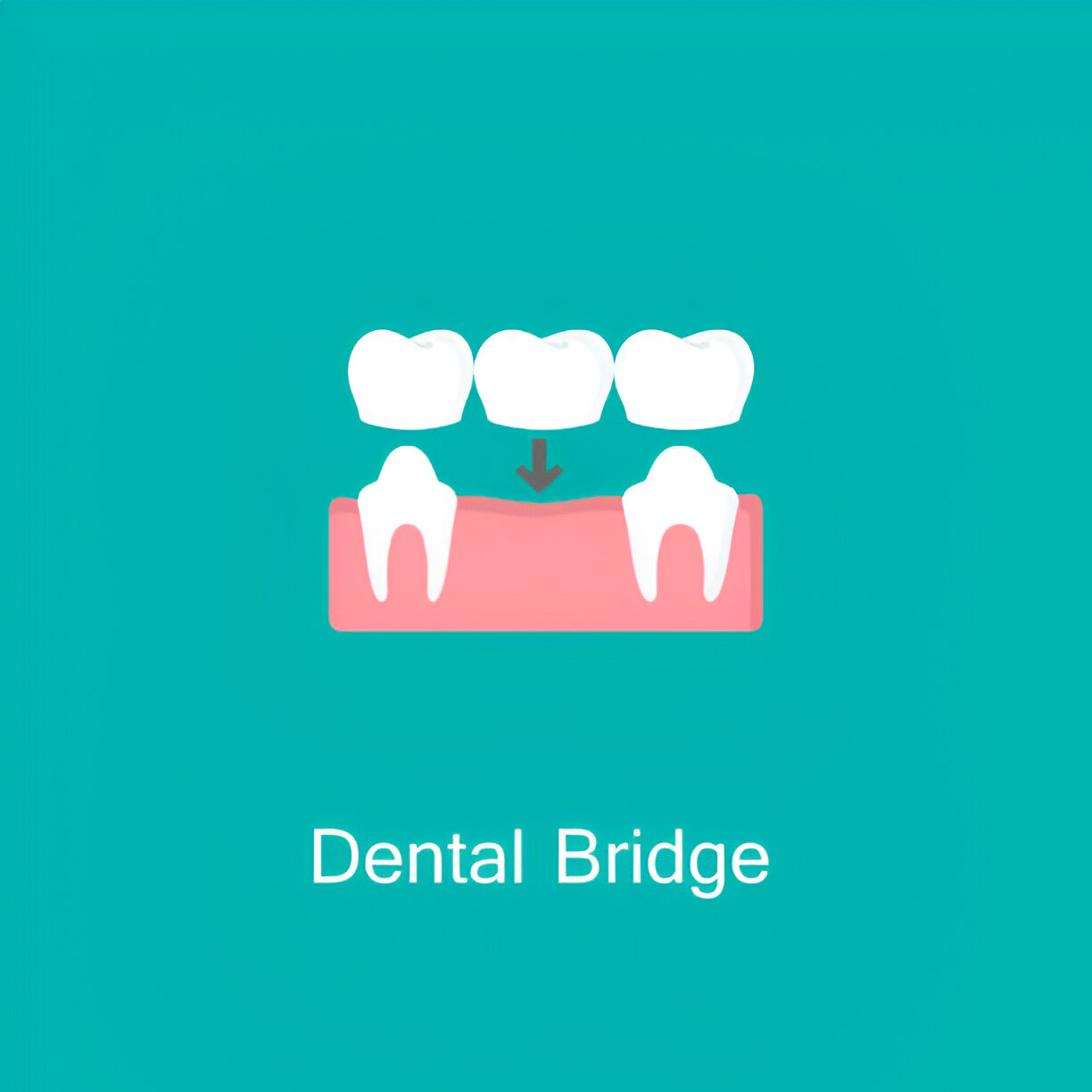 dental Bridges & Crowns fixing cost