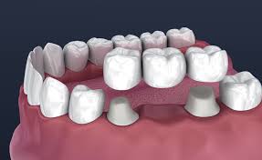 braces cost in guntur
