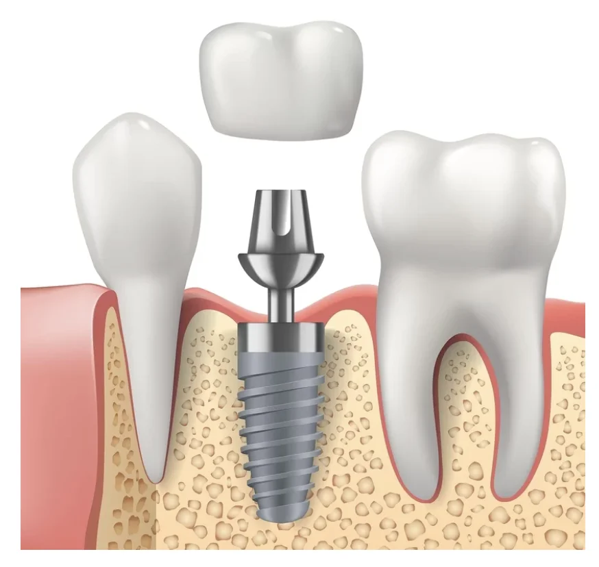 Tooth implant cost in Guntur