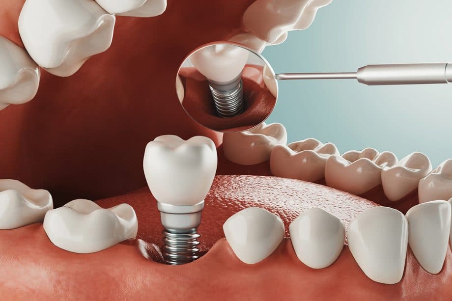 full mouth teeth implants in Guntur
