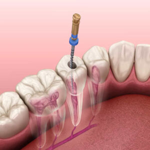 painless rootcanal treatment in Guntur