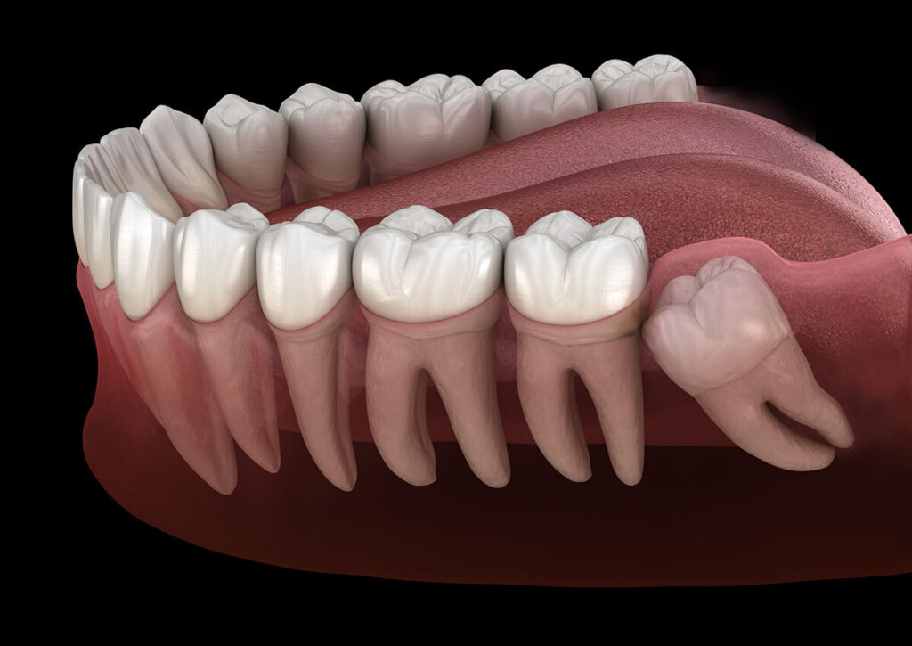 best wisdom teeth removal dental care in guntur