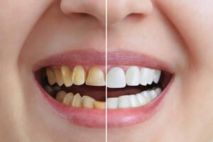 cosmetic dentistry dental implants in guntur