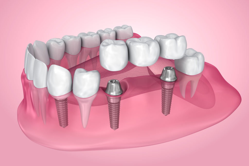 guntur dental crown clinic, kothapeta guntur