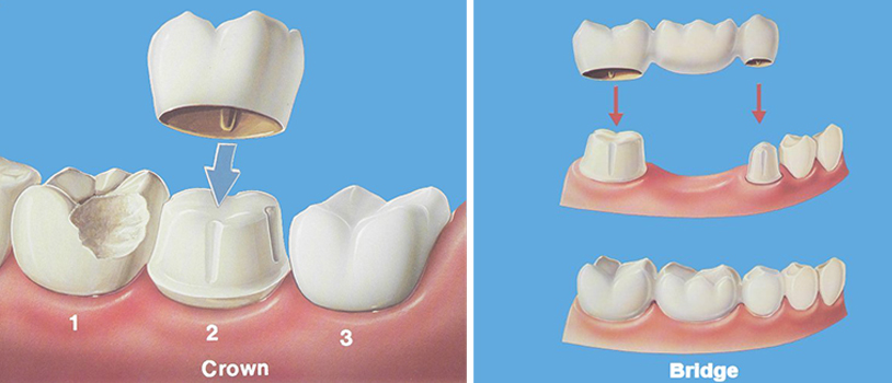 dental crown fixing cost in guntur