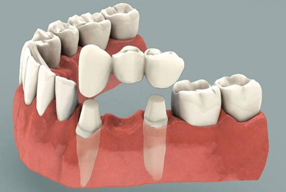 crown teeth removal hospital in guntur