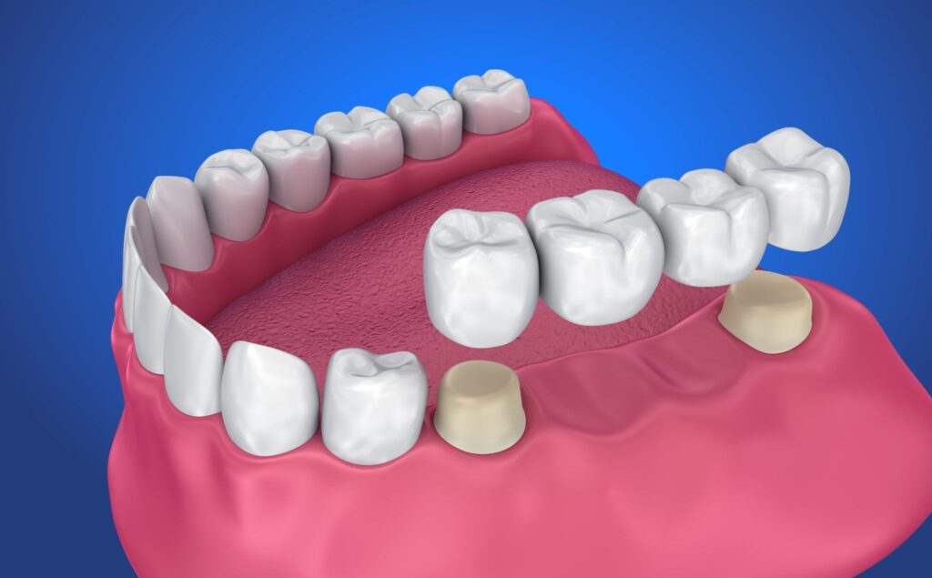 bridges front teeth in guntur