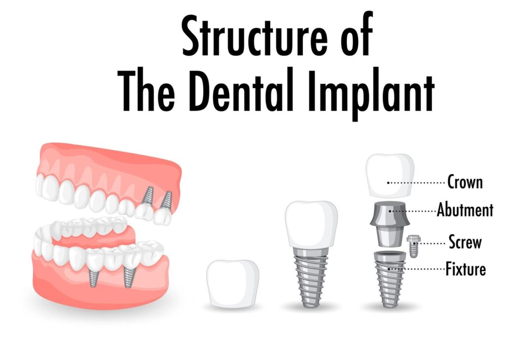 Dental implants in Guntur near me