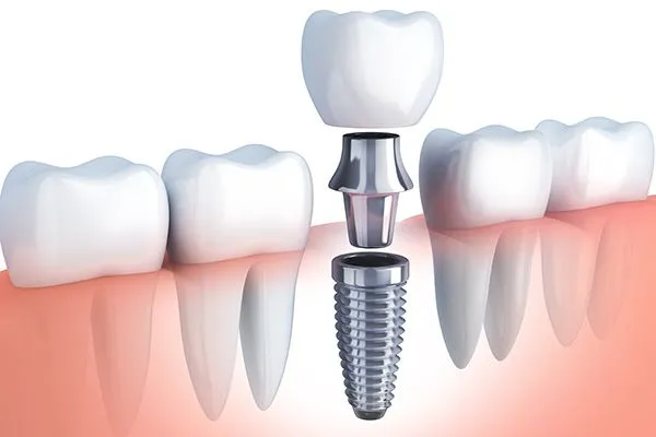 Tooth transplant cost in Guntur