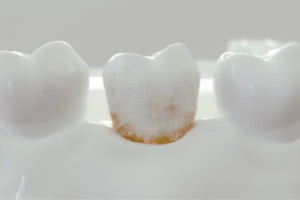 Dental plaques treatment in guntur