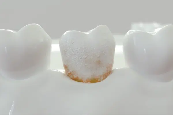 Dental plaques treatment in guntur