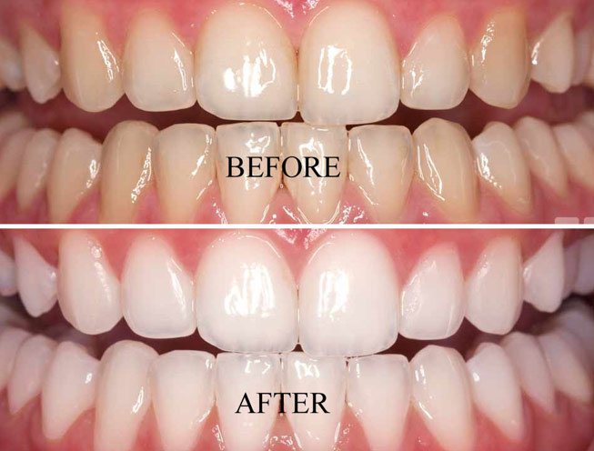 Laser teeth whitening in guntur