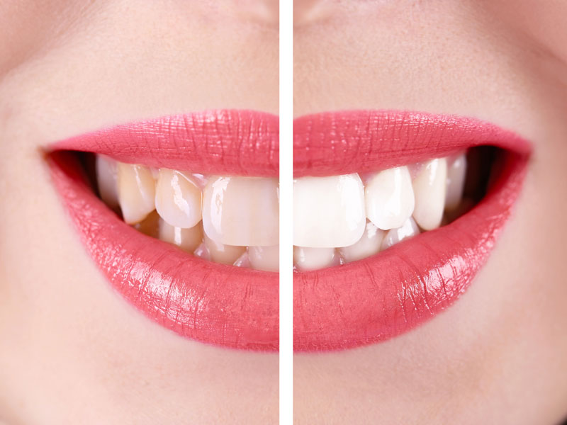 teeth whitening at dentist near me guntur