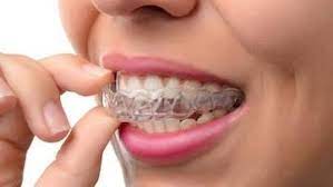 Clear aligners