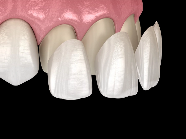 dental veneers and laminates treatment near me