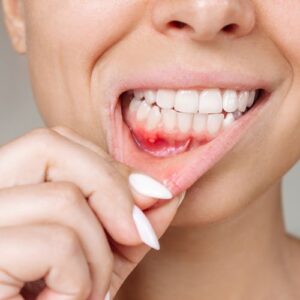 Mouth ulcers treatment near me