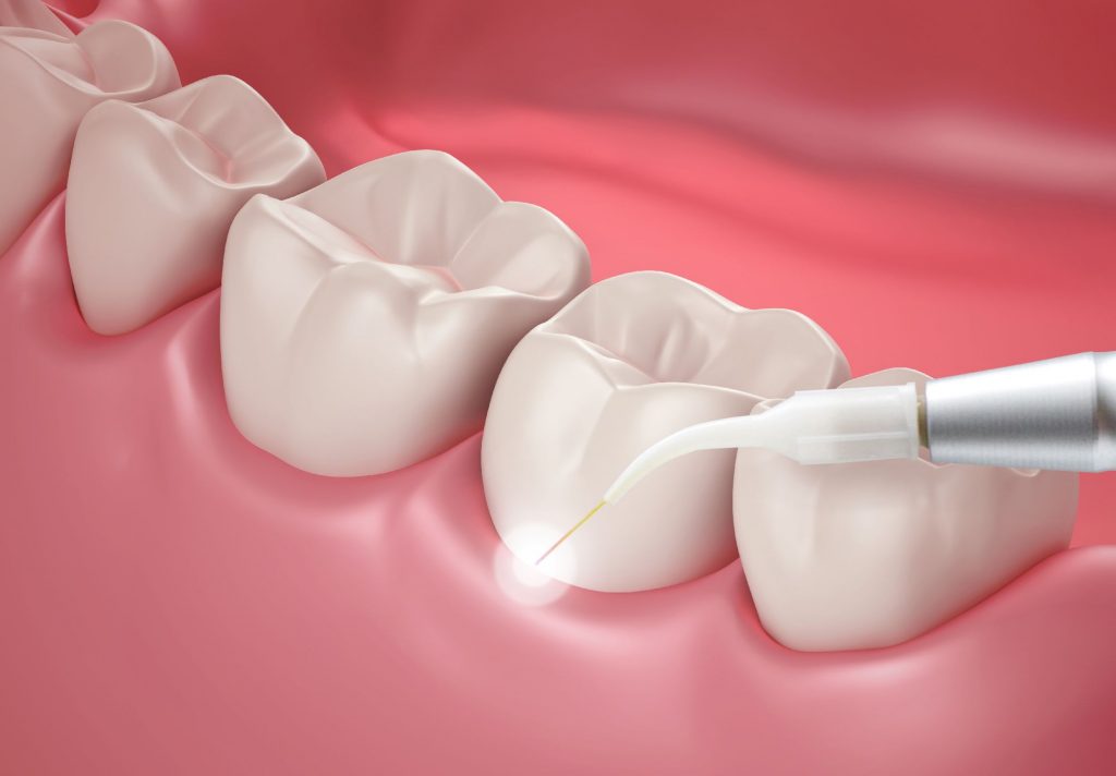 laser root canal near me