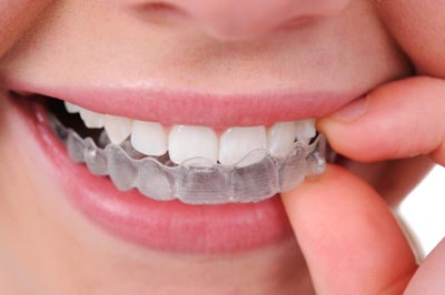 Invisalign near me