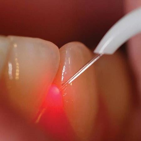 Laser gum therapy near me
