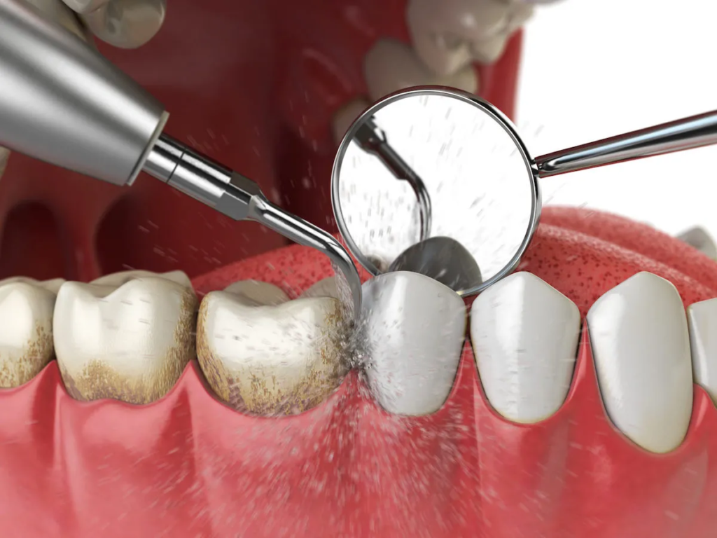 teeth cleaning cost in Guntur