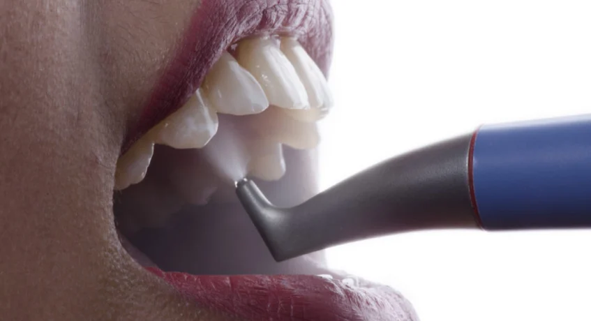 Dental air polishing in Guntur