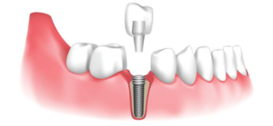 Best Dental Implant doctors in Guntur