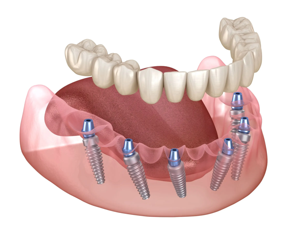 Full Mouth dental implants near me