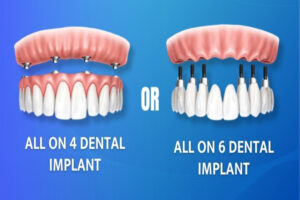 Dental implants clinic near me