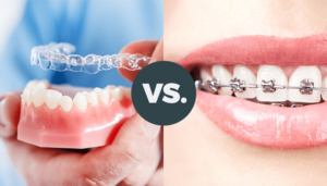 aligners and braces in Guntur