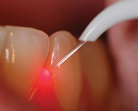 Laser dentistry guntur