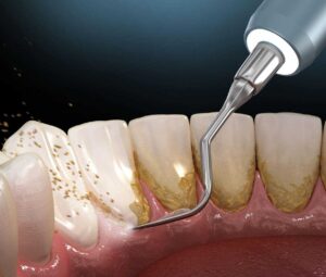 plaque treatment in Guntur