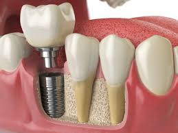 Dental Implant procedure steps explained by Guntur dentist