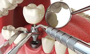 Reviews of Dental Implant services in Guntur