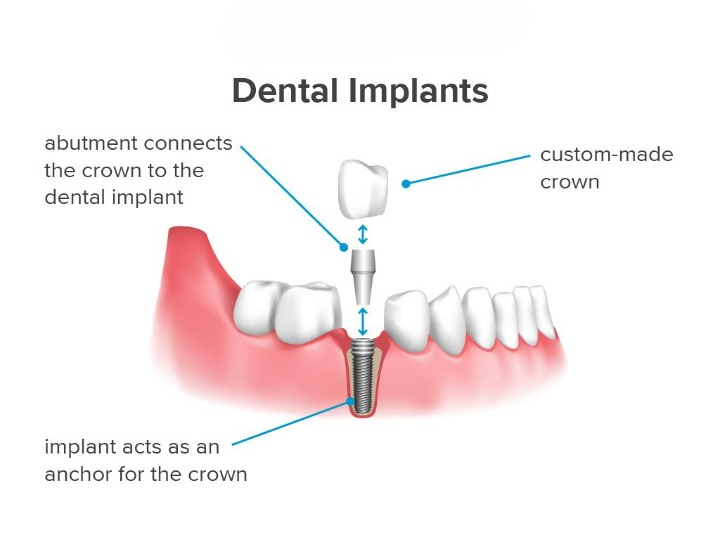 What types of dental implant materials are used in Guntur dental clinics?