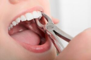 Surgical tooth extraction near me in Guntur