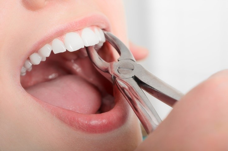 Surgical tooth extraction near me in Guntur
