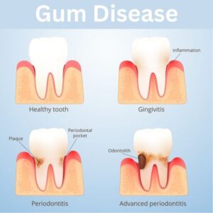 Gum disease causes and preventions
