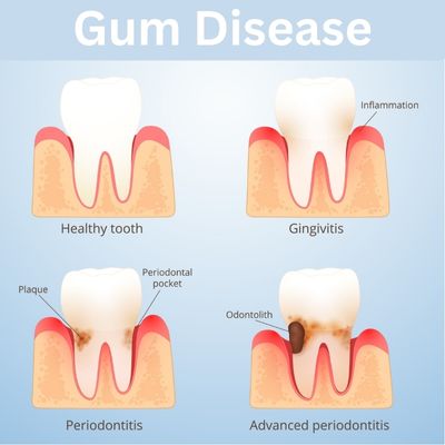 Gum disease causes and preventions