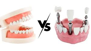 dental implants vs dentures: cost in india